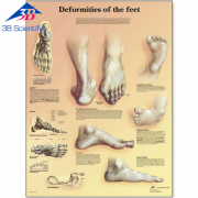 발 기형 차트 Deformities of the Feet Chart VR1185L
